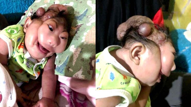 Bayi Anugrah Arshaka Yang Lagi Viral di Donggala Berikut Fakta Selengkapnya